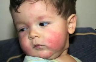 娱乐吃瓜酱过敏